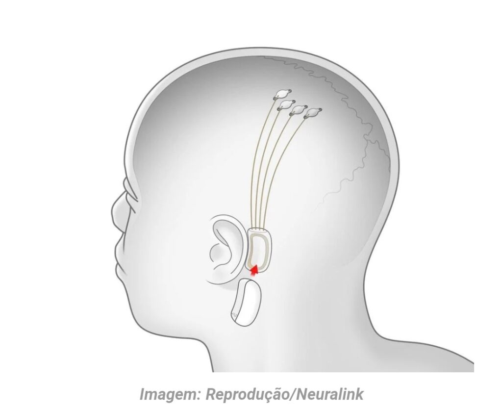 PROJETO AUDACIOSO QUER IMPLEMENTAR CHIP NO CÉREBRO QUE AJUDARÁ PESSOAS PARAPLÉGICA A ANDAR